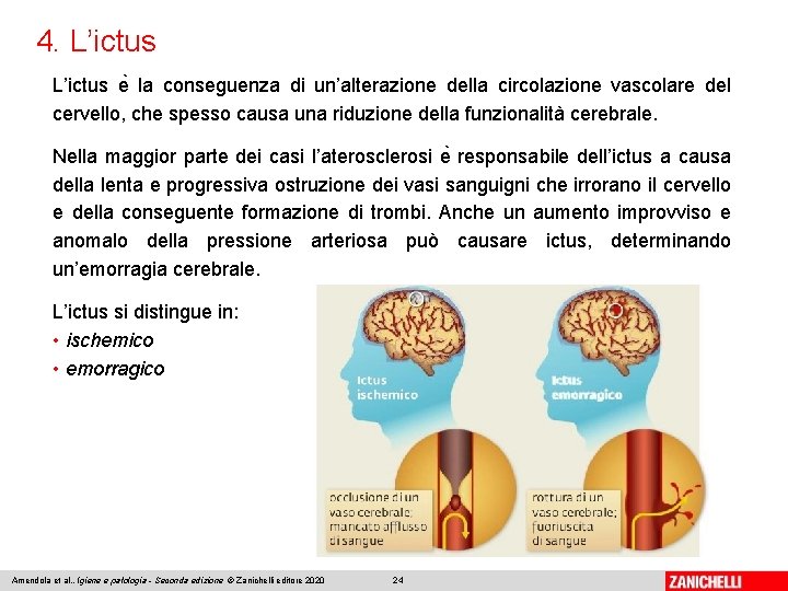 4. L’ictus e la conseguenza di un’alterazione della circolazione vascolare del cervello, che spesso