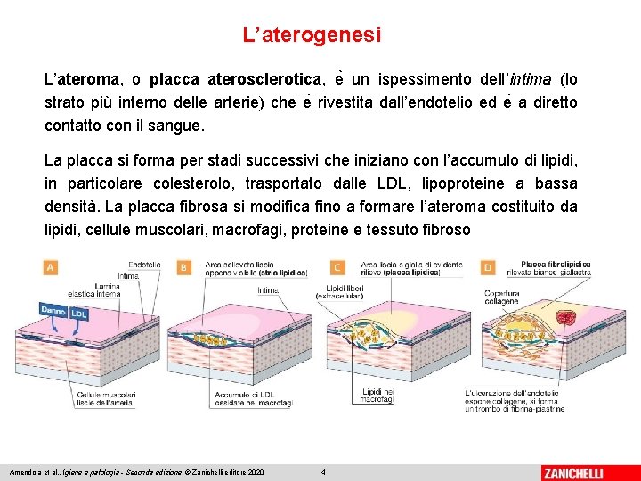 L’aterogenesi L’ateroma, o placca aterosclerotica, e un ispessimento dell’intima (lo strato più interno delle