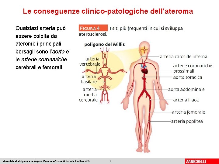 Le conseguenze clinico-patologiche dell’ateroma Qualsiasi arteria può essere colpita da ateromi; i principali bersagli