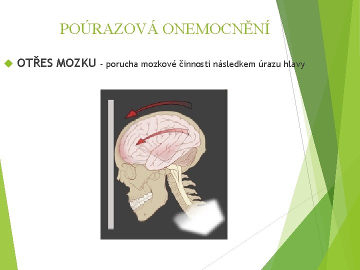 POÚRAZOVÁ ONEMOCNĚNÍ OTŘES MOZKU - porucha mozkové činnosti následkem úrazu hlavy 