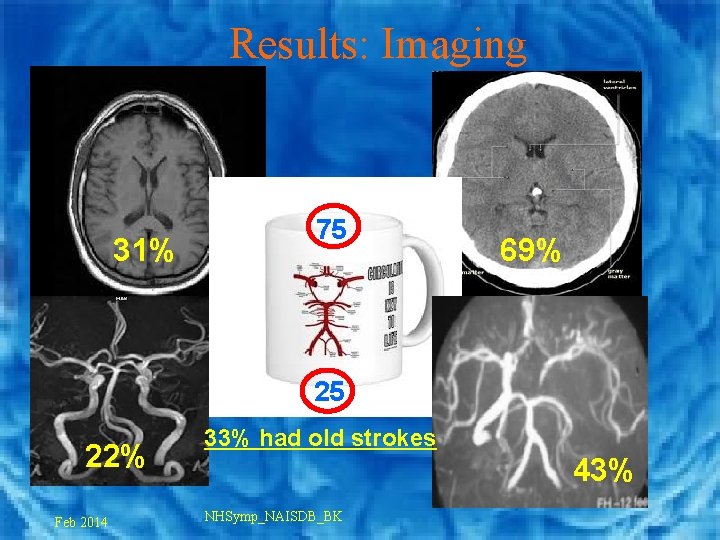 Results: Imaging 31% 75 69% 25 22% Feb 2014 33% had old strokes 43%