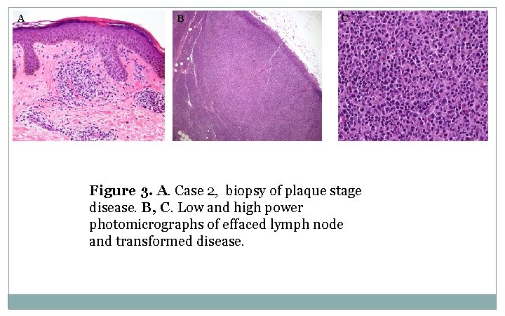 A B C Figure 3. A. Case 2, biopsy of plaque stage disease. B,