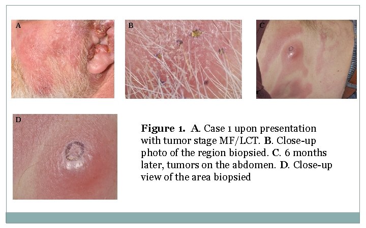 A D B C Figure 1. A. Case 1 upon presentation with tumor stage