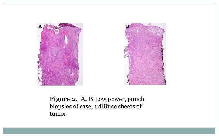A B Figure 2. A, B Low power, punch biopsies of case, 1 diffuse