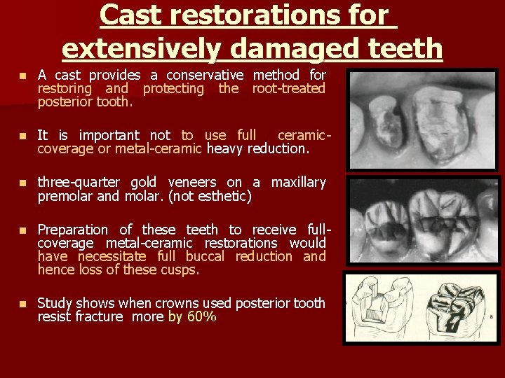 Cast restorations for extensively damaged teeth n A cast provides a conservative method for