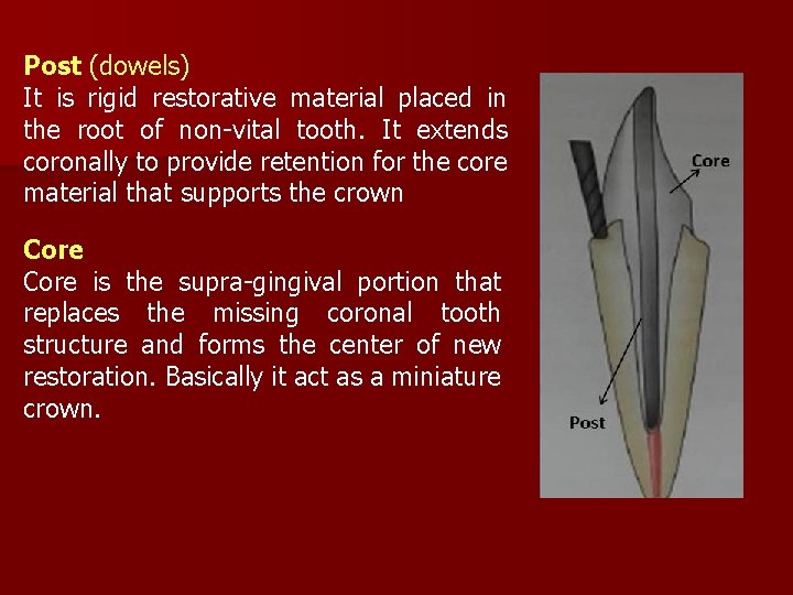 Post (dowels) It is rigid restorative material placed in the root of non-vital tooth.