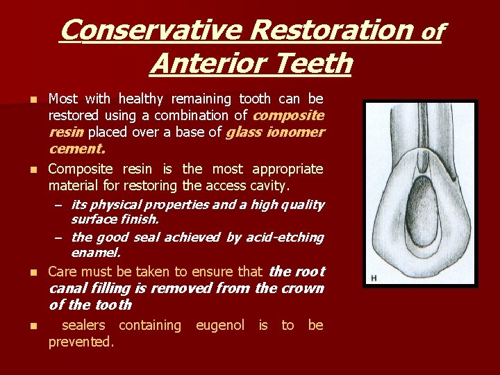 Conservative Restoration of Anterior Teeth n Most with healthy remaining tooth can be restored