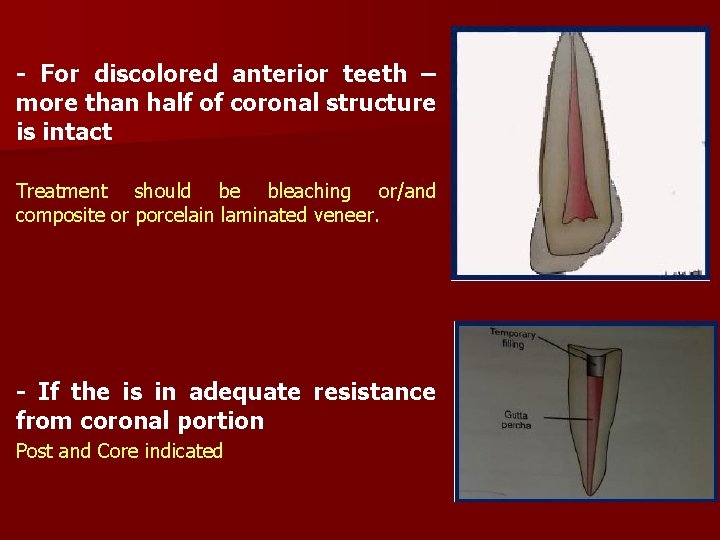 - For discolored anterior teeth – more than half of coronal structure is intact