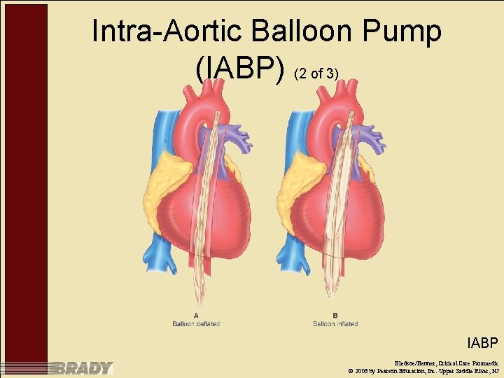 Intra-Aortic Balloon Pump (IABP) (2 of 3) IABP Bledsoe/Benner, Critical Care Paramedic © 2006