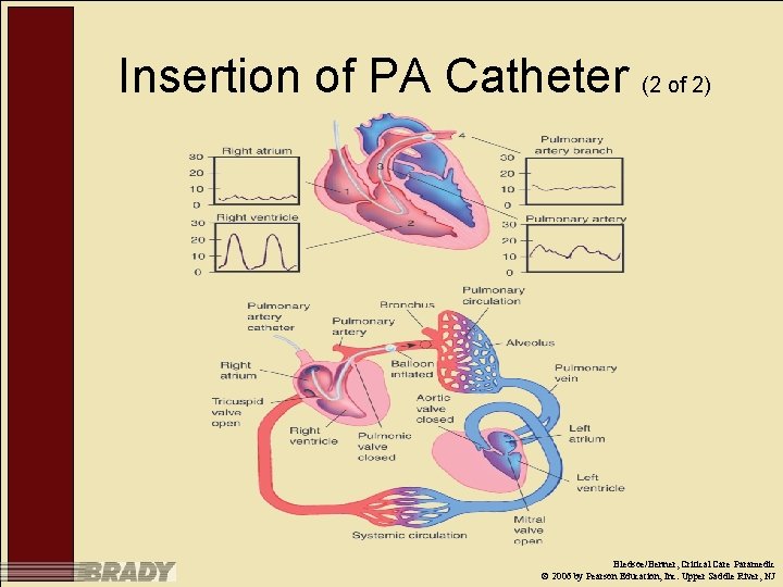 Insertion of PA Catheter (2 of 2) Bledsoe/Benner, Critical Care Paramedic © 2006 by