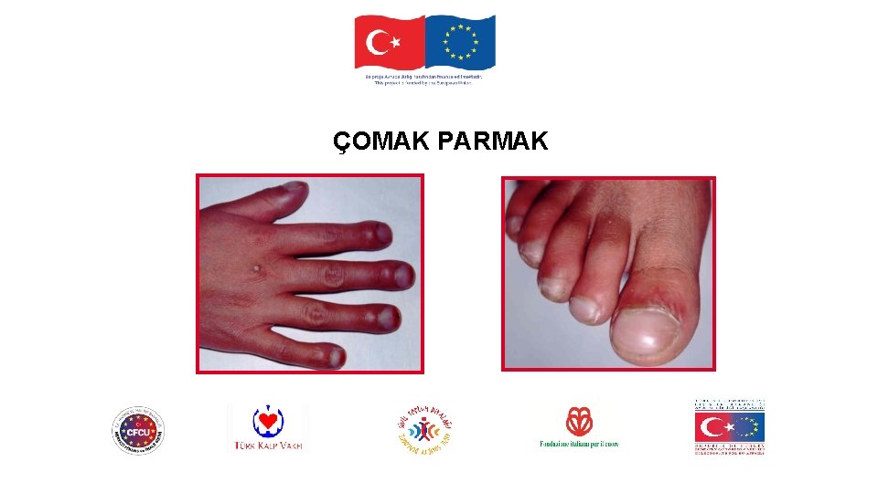 ÇOMAK PARMAK 