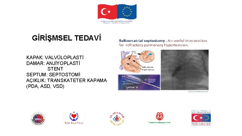 GİRİŞMSEL TEDAVİ KAPAK: VALVÜLOPLASTİ DAMAR: ANJİYOPLASTİ STENT SEPTUM: SEPTOSTOMİ AÇIKLIK: TRANSKATETER KAPAMA (PDA, ASD,