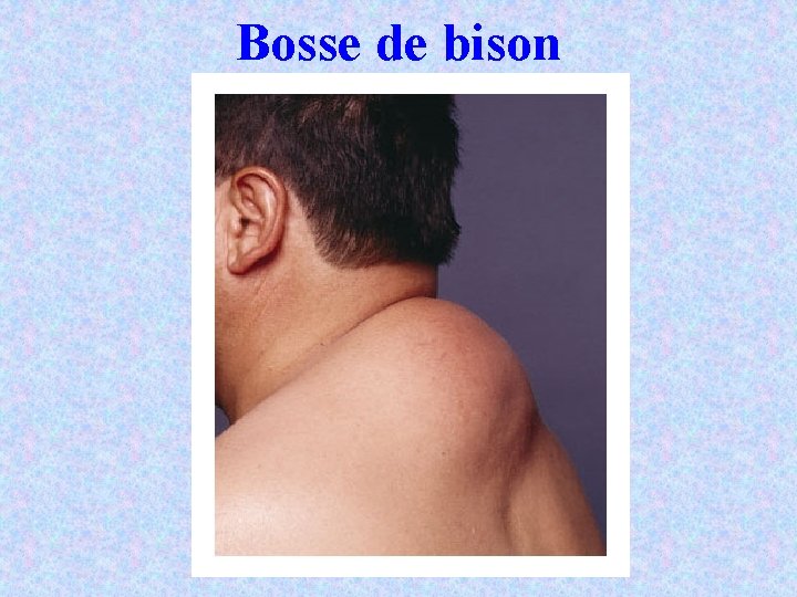 Bosse de bison 