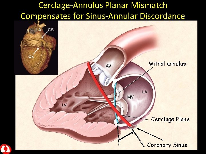 Cerclage-Annulus Planar Mismatch Compensates for Sinus-Annular Discordance Mitral annulus Cerclage Plane Coronary Sinus 