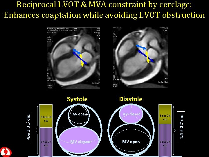 Reciprocal LVOT & MVA constraint by cerclage: Enhances coaptation while avoiding LVOT obstruction 2.