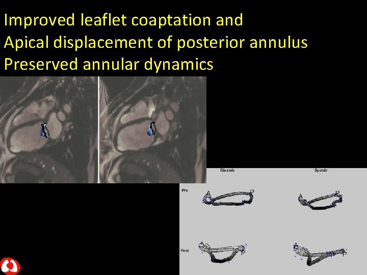 Improved leaflet coaptation and Apical displacement of posterior annulus Preserved annular dynamics 
