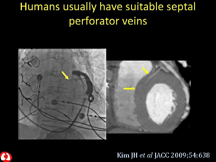 Humans usually have suitable septal perforator veins Kim JH et al JACC 2009; 54: