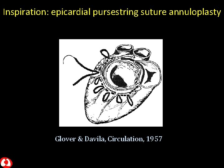 Inspiration: epicardial pursestring suture annuloplasty Glover & Davila, Circulation, 1957 