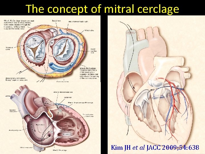 The concept of mitral cerclage Kim JH et al JACC 2009; 54: 638 