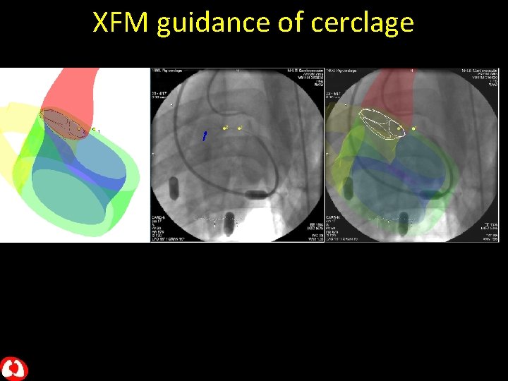 XFM guidance of cerclage 