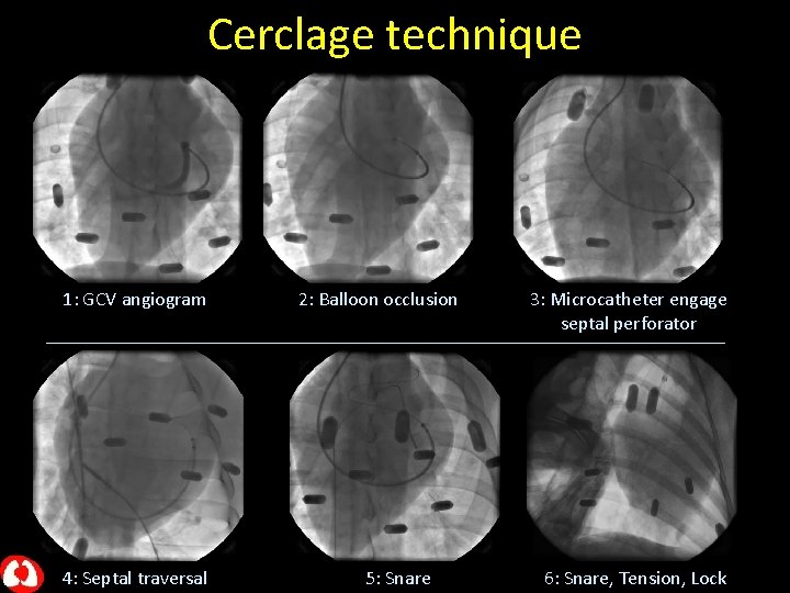 Cerclage technique 1: GCV angiogram 4: Septal traversal 2: Balloon occlusion 5: Snare 3: