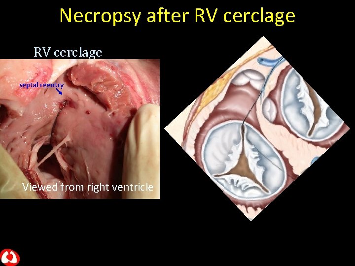 Necropsy after RV cerclage septal reentry Viewed from right ventricle 