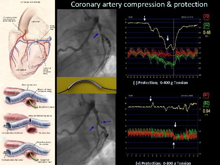 Coronary artery compression & protection (-) Protection; 0 -400 g Tension D (+) Protection;