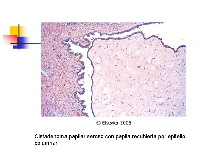 Cistadenoma papilar seroso con papila recubierta por epitelio columnar 