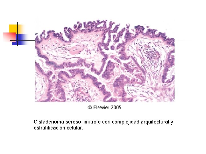 Cistadenoma seroso limítrofe con complejidad arquitectural y estratificación celular. 