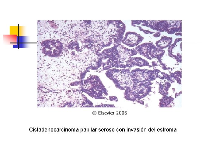 Cistadenocarcinoma papilar seroso con invasión del estroma 