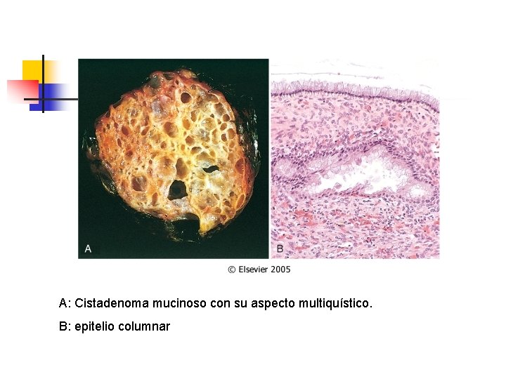 A: Cistadenoma mucinoso con su aspecto multiquístico. B: epitelio columnar 