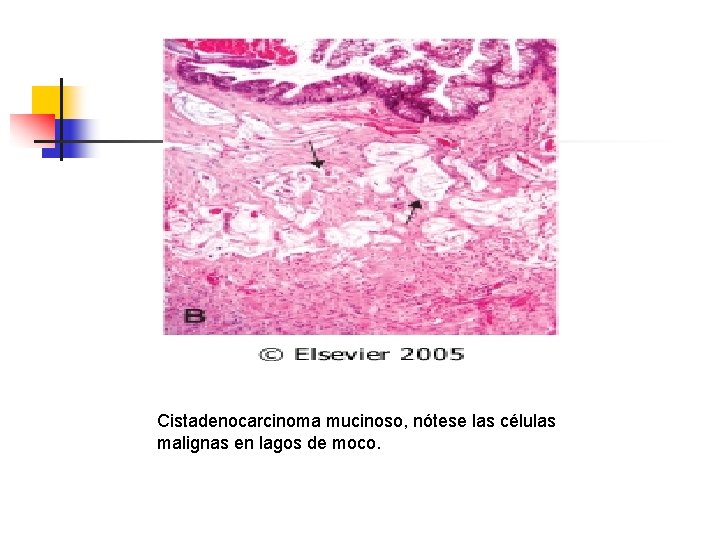 Cistadenocarcinoma mucinoso, nótese las células malignas en lagos de moco. 