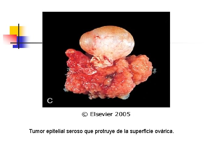 Tumor epitelial seroso que protruye de la superficie ovárica. 