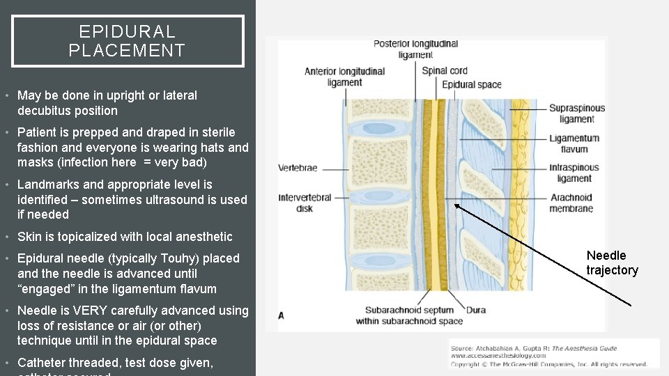 EPIDURAL PLACEMENT • May be done in upright or lateral decubitus position • Patient