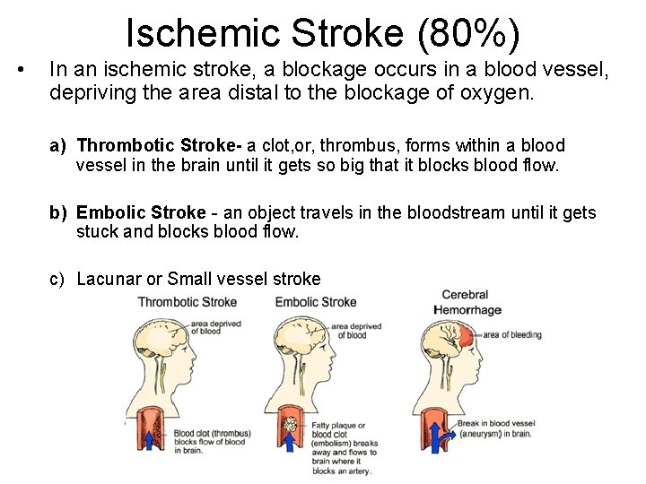 Ischemic Stroke (80%) • In an ischemic stroke, a blockage occurs in a blood