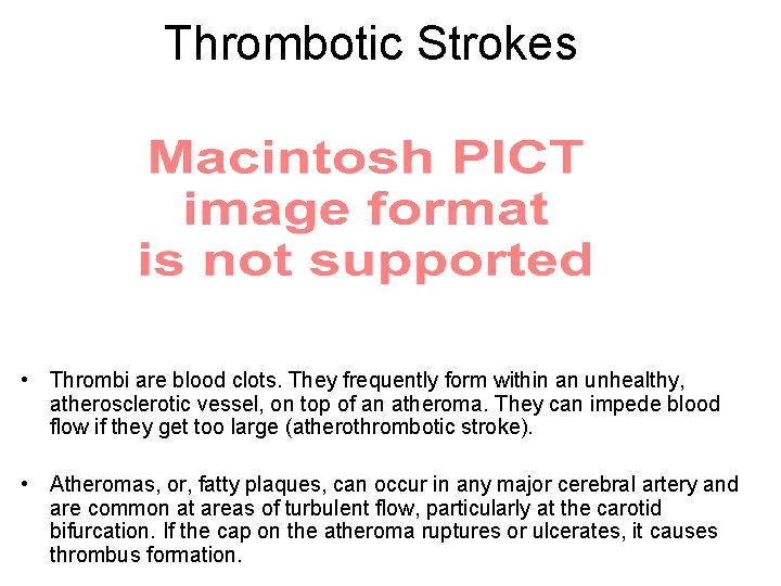 Thrombotic Strokes • Thrombi are blood clots. They frequently form within an unhealthy, atherosclerotic