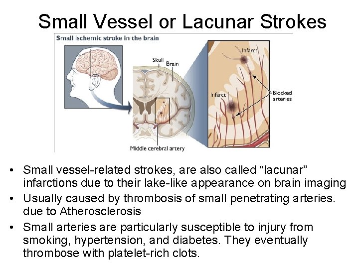 Small Vessel or Lacunar Strokes • Small vessel-related strokes, are also called “lacunar” infarctions