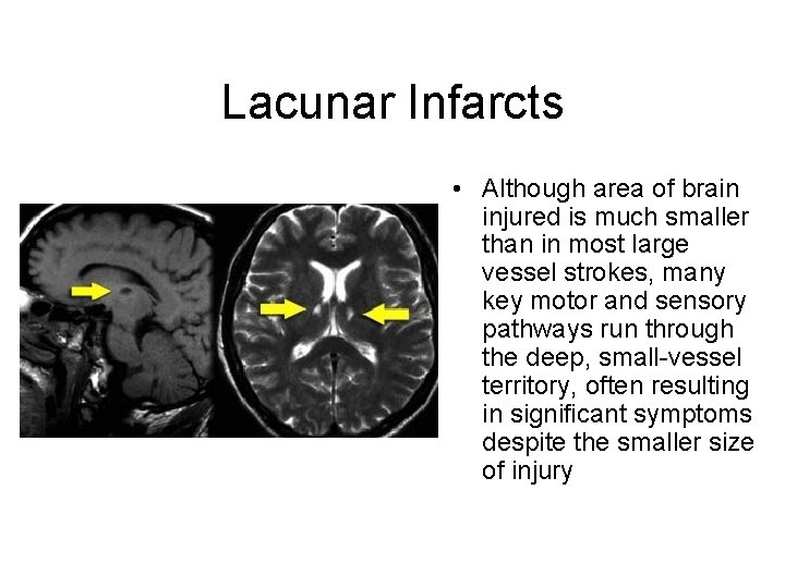 Lacunar Infarcts • Although area of brain injured is much smaller than in most