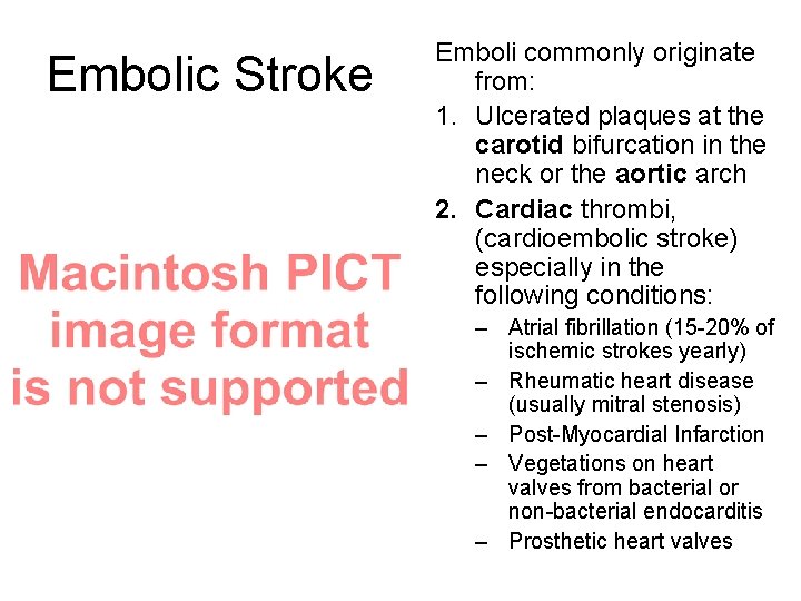 Embolic Stroke Emboli commonly originate from: 1. Ulcerated plaques at the carotid bifurcation in