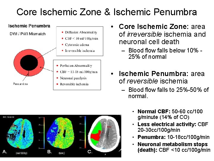 Core Ischemic Zone & Ischemic Penumbra • Core Ischemic Zone: area of irreversible ischemia