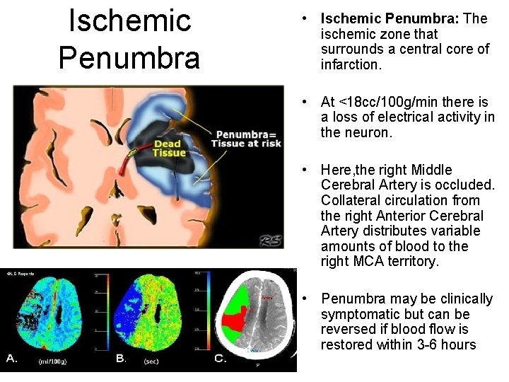 Ischemic Penumbra • Ischemic Penumbra: The ischemic zone that surrounds a central core of