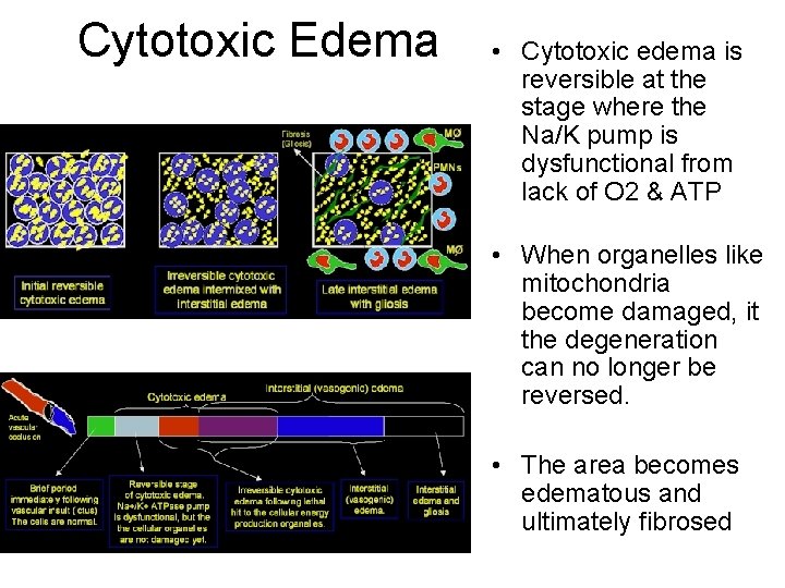 Cytotoxic Edema • Cytotoxic edema is reversible at the stage where the Na/K pump