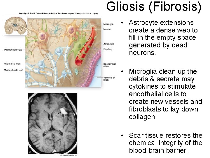 Gliosis (Fibrosis) • Astrocyte extensions create a dense web to fill in the empty