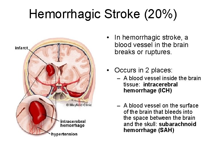 Hemorrhagic Stroke (20%) • In hemorrhagic stroke, a blood vessel in the brain breaks