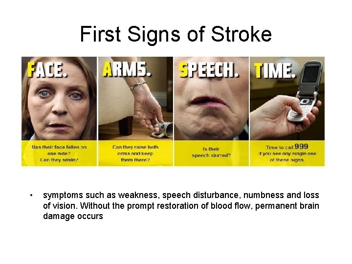 First Signs of Stroke • symptoms such as weakness, speech disturbance, numbness and loss