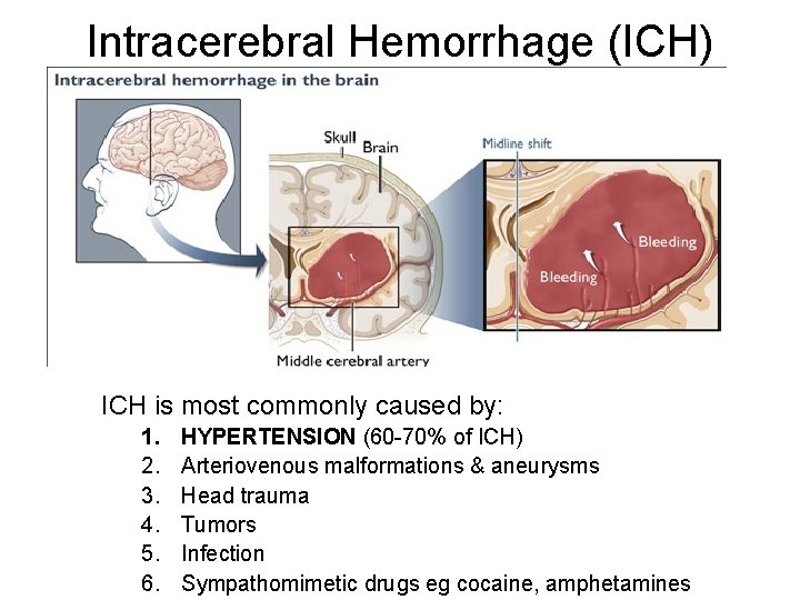 Intracerebral Hemorrhage (ICH) ICH is most commonly caused by: 1. 2. 3. 4. 5.