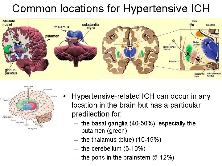 Common locations for Hypertensive ICH • Hypertensive-related ICH can occur in any location in