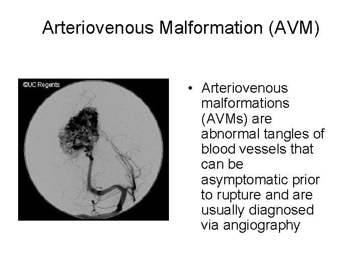 Arteriovenous Malformation (AVM) • Arteriovenous malformations (AVMs) are abnormal tangles of blood vessels that