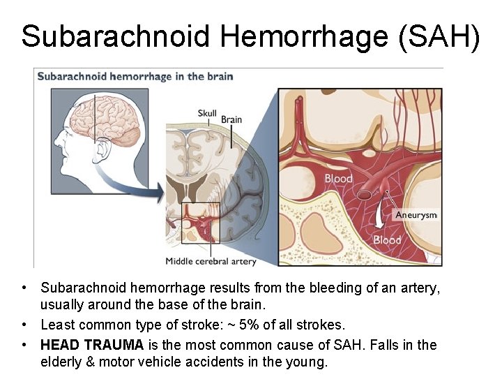 Subarachnoid Hemorrhage (SAH) • Subarachnoid hemorrhage results from the bleeding of an artery, usually