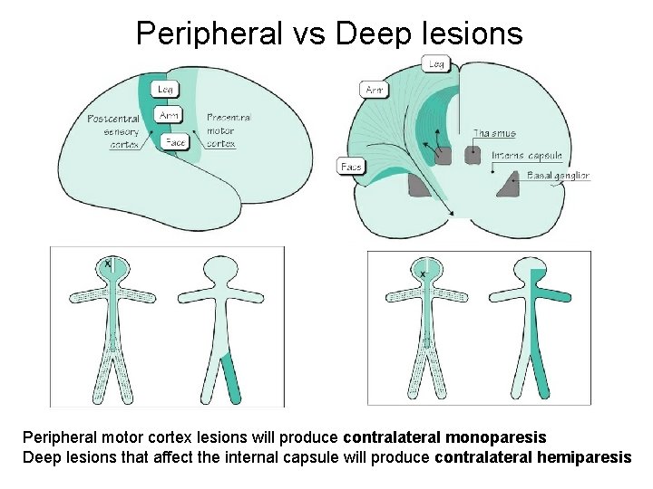 Peripheral vs Deep lesions Peripheral motor cortex lesions will produce contralateral monoparesis Deep lesions